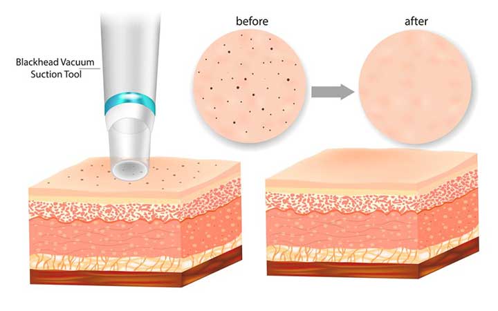 DermaSuction Facial Pore Vacuum Review